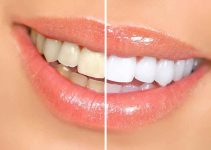 At-Home Teeth Whitening for A Brighter Smile