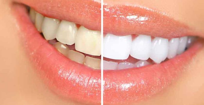 At-Home Teeth Whitening for A Brighter Smile