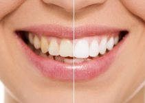 All You Need to Know About Teeth Whitening