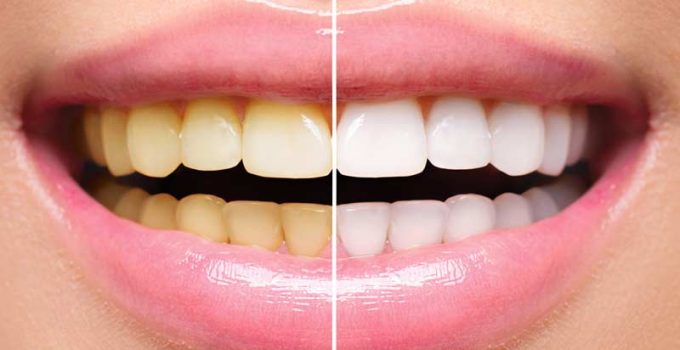 How to prevent negative effects in the teeth whitening process?