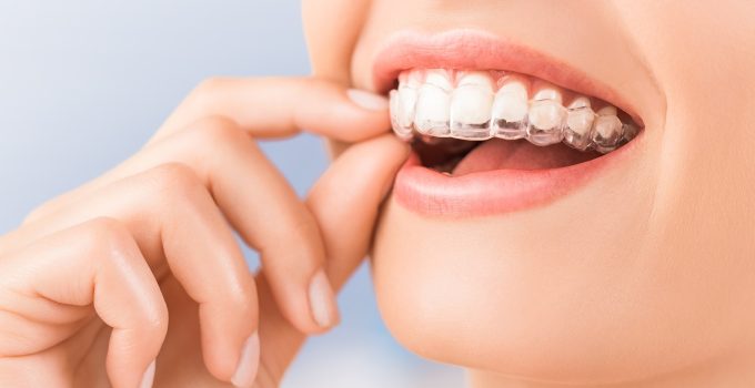 Discover Your Dream Smile with Invisalign at Discovery Dental