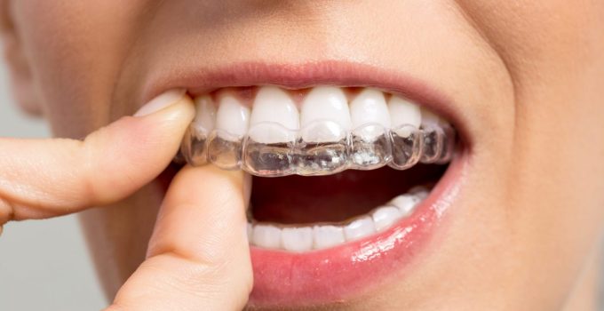 Invisalign: Unlocking the Smile of Your Dreams at West Side Dental Center