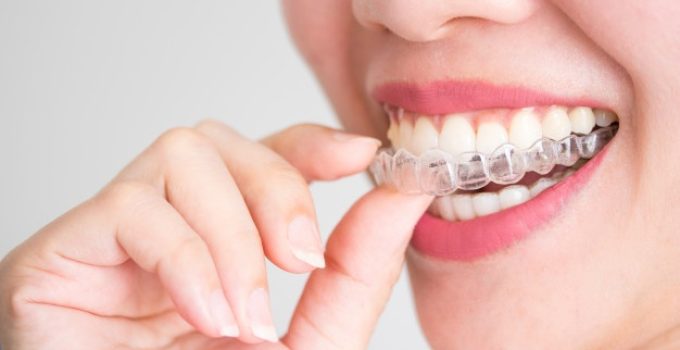 Invisalign: Your Path to the Smile of Your Dreams at V Smile Family Dental