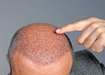 Why London is the Top Destination for Hair Transplants