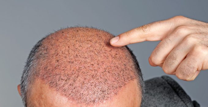 Why London is the Top Destination for Hair Transplants