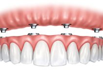 Full Arch Dental Implants: A Permanent Solution for Missing Teeth