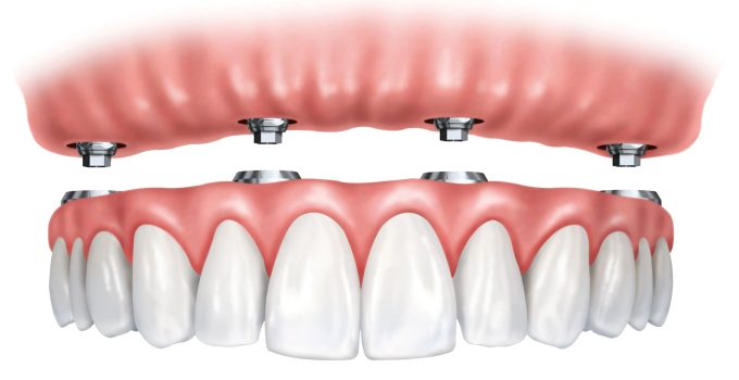 Full Arch Dental Implants: A Permanent Solution for Missing Teeth