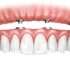 Full Arch Dental Implants: A Permanent Solution for Missing Teeth