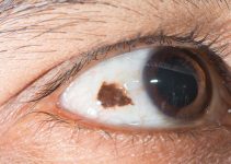Is Conjunctival Naevus Removal a Cosmetic or Medical Procedure?