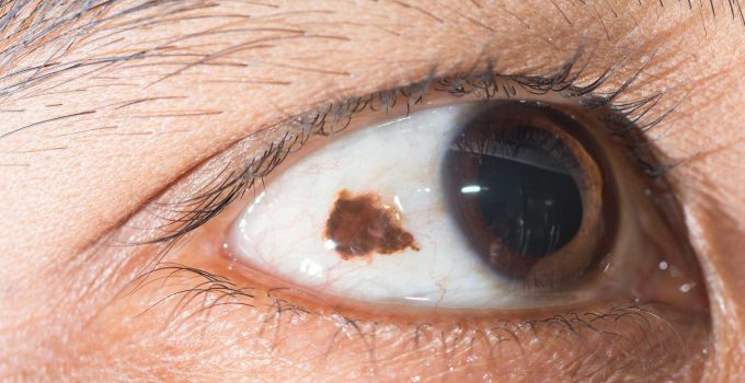 Is Conjunctival Naevus Removal a Cosmetic or Medical Procedure?
