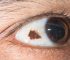 Is Conjunctival Naevus Removal a Cosmetic or Medical Procedure?