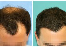 What to Expect from a Hair Transplant in the UK: A Patient’s Guide