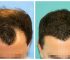 What to Expect from a Hair Transplant in the UK: A Patient’s Guide